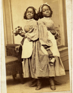 Millie and Christine Mckoy were conjoined at the lower spine. 