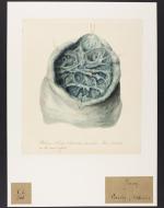 Phthisis Drawing, 1820.