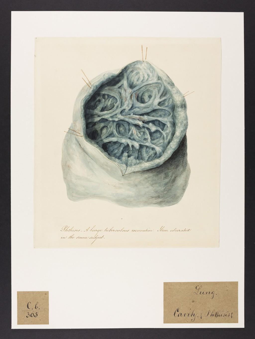 Phthisis Drawing, 1820.